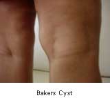 Bakers Cyst